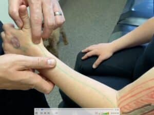 Upper Extremity Crush Injury: A Case Study