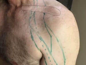 Assessment & Electro-Acupuncture for Thoracic Outlet Syndrome/TOS