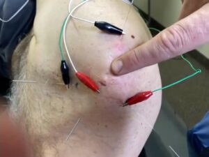 Scar Threading: Clinical Significance of Using Acupuncture to Treat Cutaneous Scars