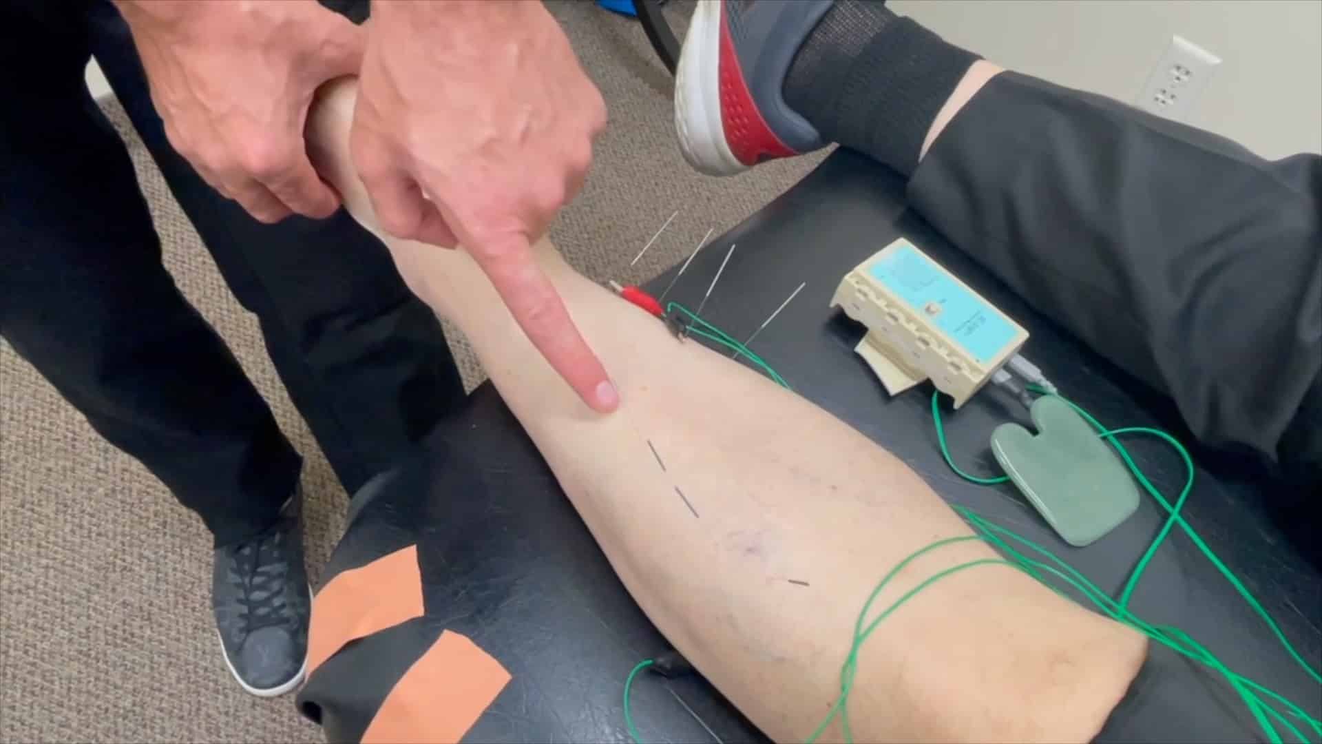 Clinician pointing at a patient’s leg during electrical stimulation therapy with wires and a handheld stimulator on a table nearby.